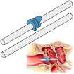 The Silverstein MicroWick is a minimally invasive system for delivering fluids and medications directly to the inner ear