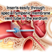 Inserts easily through special tympanic membrane vent tube
